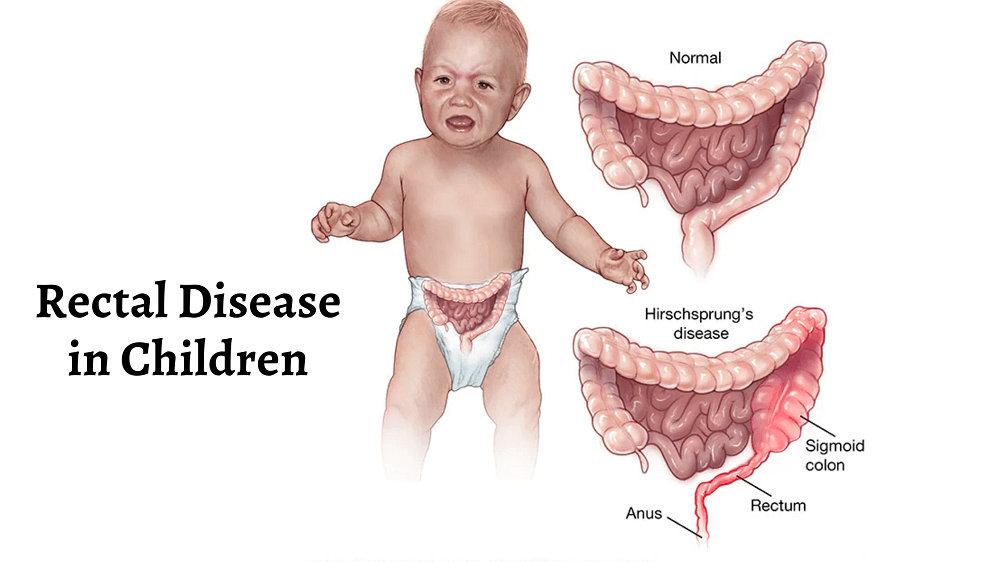 Read more about the article Rectal Disease in Children
